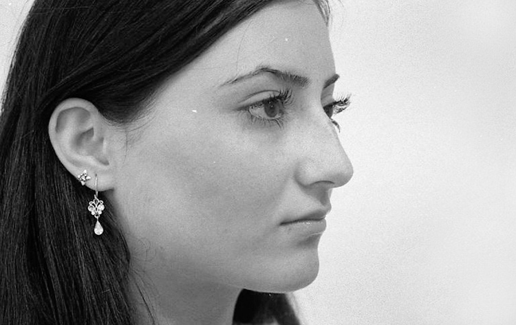 Einfache Höckernase. Vor der Operation.