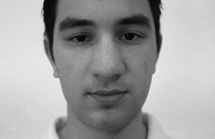 Unförmig breite Nase. Vor der Operation. 